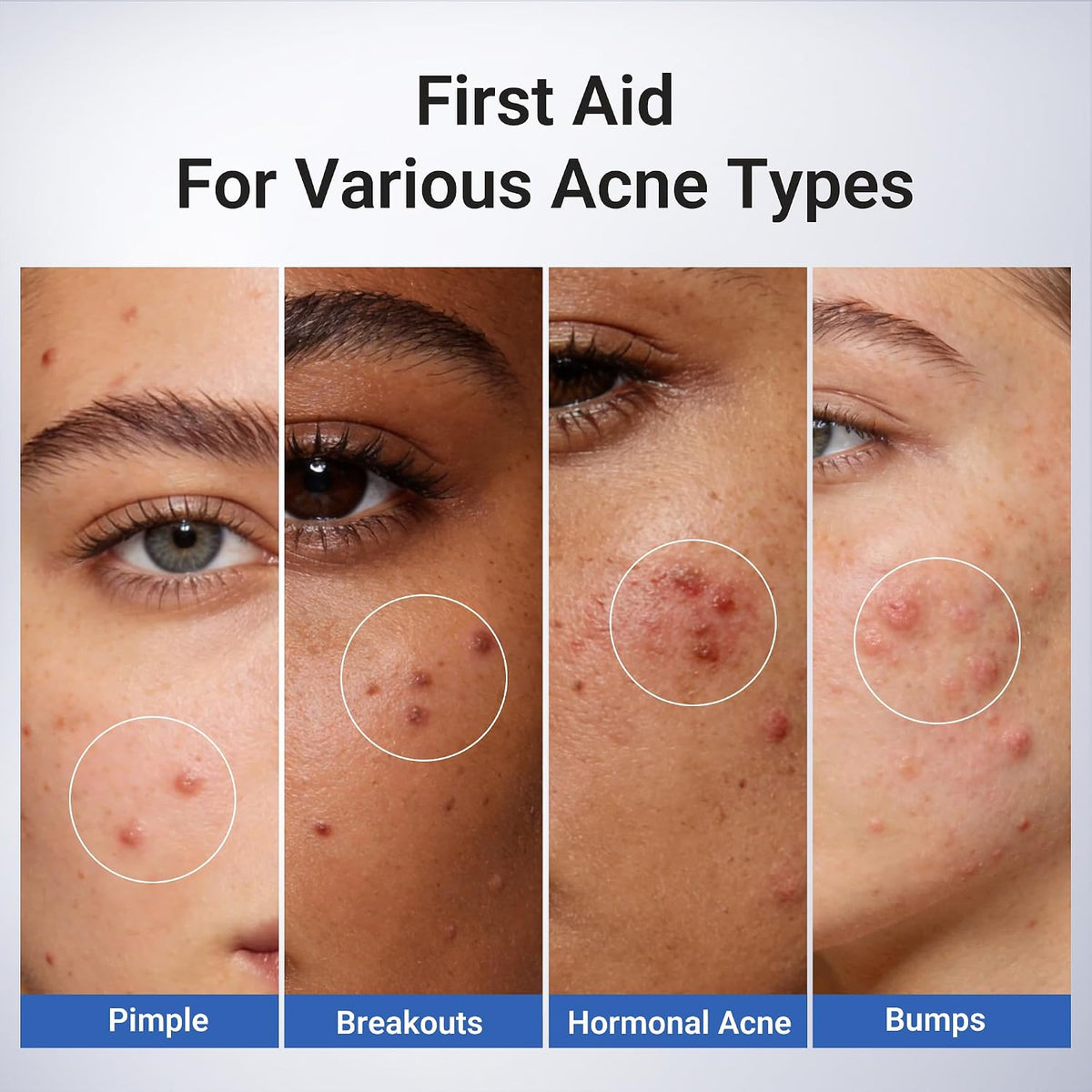 Powerful 1.8% Salicylic Acid Acne Spot Treatment - Fast-Acting Drying Lotion, 0.34 Oz