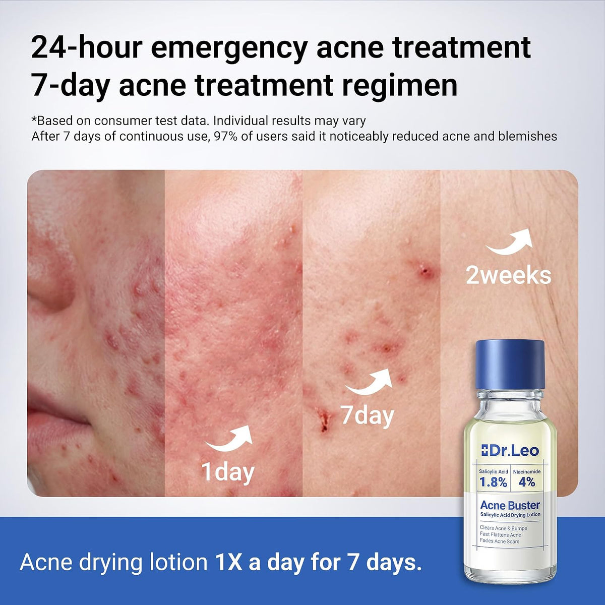Powerful 1.8% Salicylic Acid Acne Spot Treatment - Fast-Acting Drying Lotion, 0.34 Oz